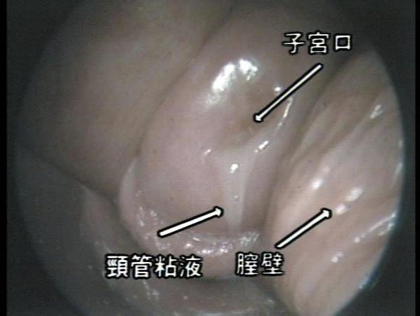 子宮口と頸管粘液、膣壁の画像
